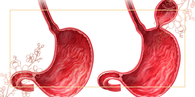فتق چیست و انواع آن کدام است؟