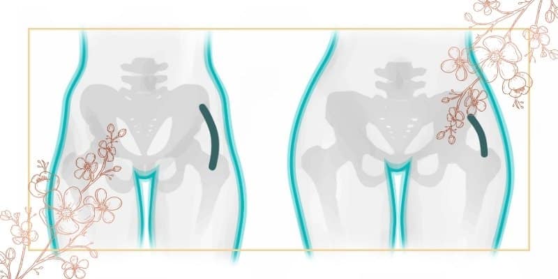 ورزش برای پُر کردن گودی بغل ران