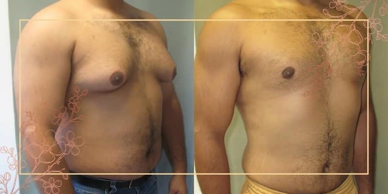 درمان چربی سینه و ژنیکوماستی در مردان