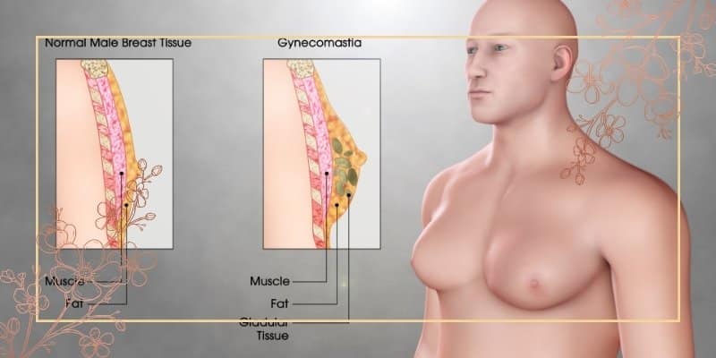 دلایل افزایش چربی سینه مردان چیست؟